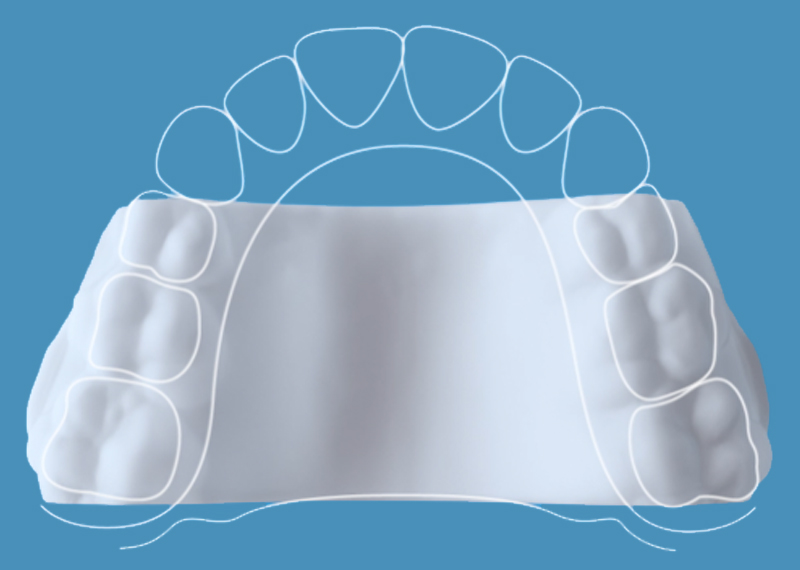 Palatal Expander