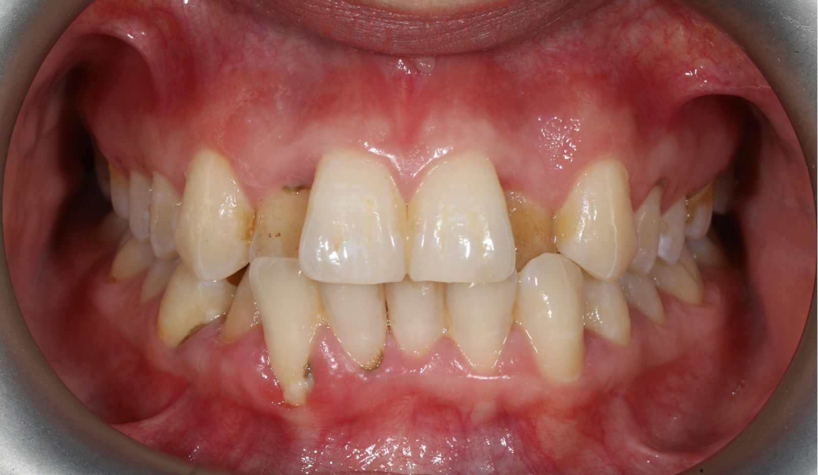Periodontal Problemli Dişlerde Şeffaf Plaklarla Ortodontik Tedavi