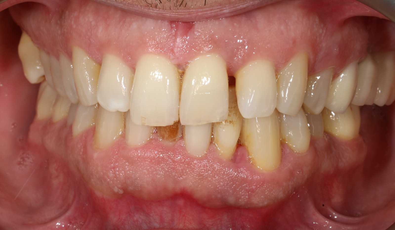 Periodontal Problemlerin Tedavisi ve Ortodontik Tedavi İle Diş Desteğinin Arttırılması