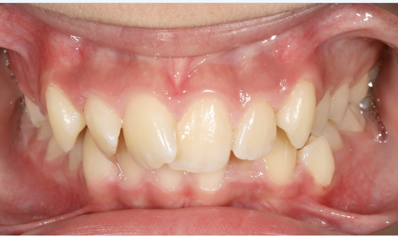 Şeffaf Plak invisalign Tedavisi