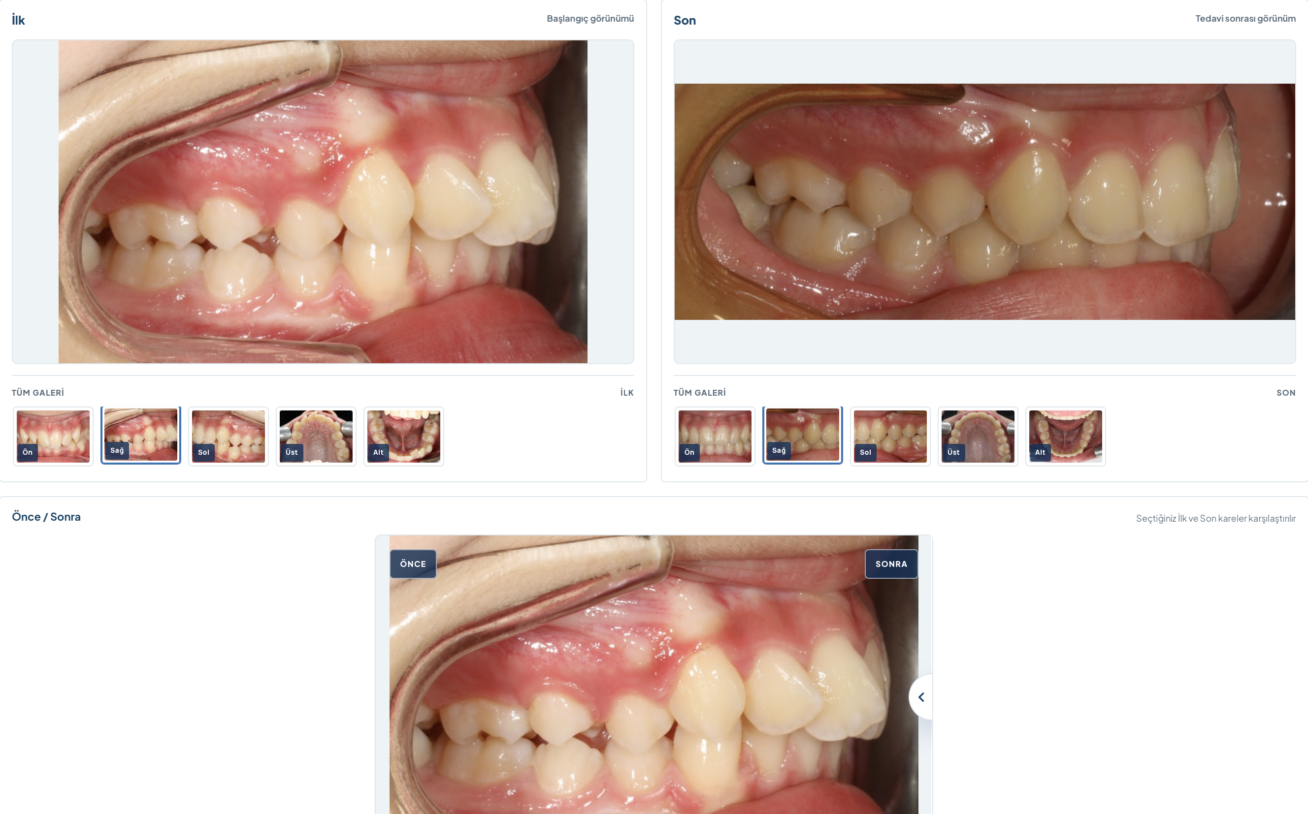 Şeffaf Plak invisalign Tedavisi