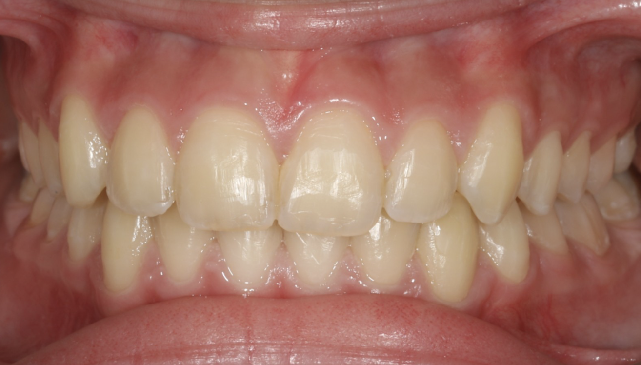 Şeffaf Plak invisalign Tedavisi