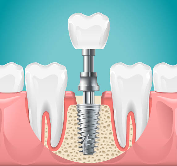 implant
